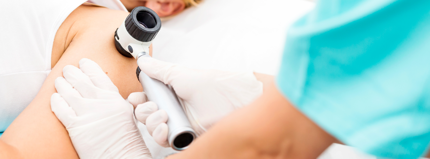 melanoma