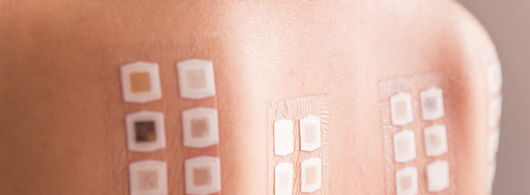 patch test